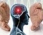 مغزی e1462960100714 - سکته مغزی شایعترین علت معلولیت/فرصت طلایی برای درمان چهار ساعت